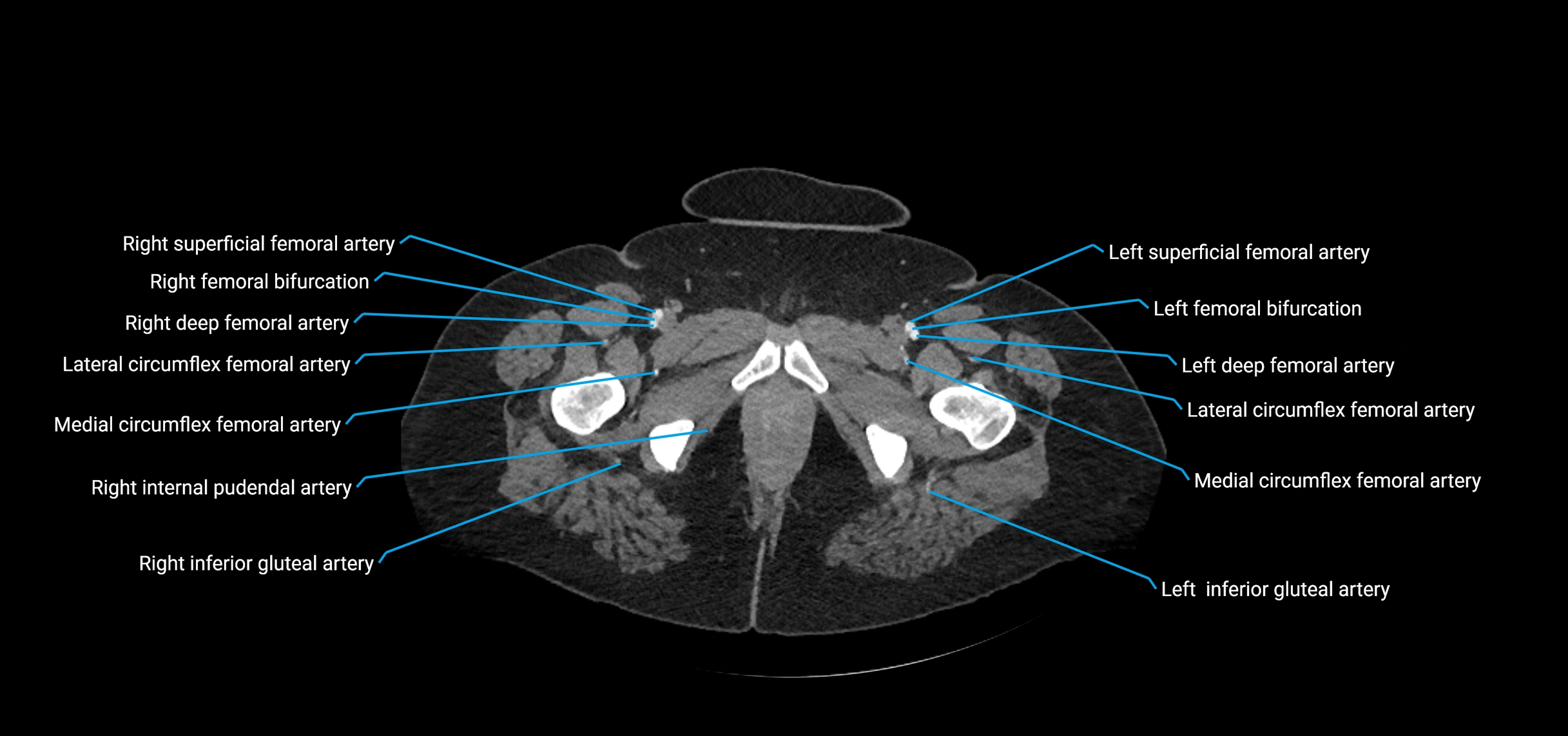 CTA abdomen axial cross sectional anatomy labelled image_272 (2).webp